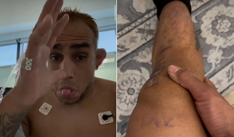 tony ferguson traumatismos