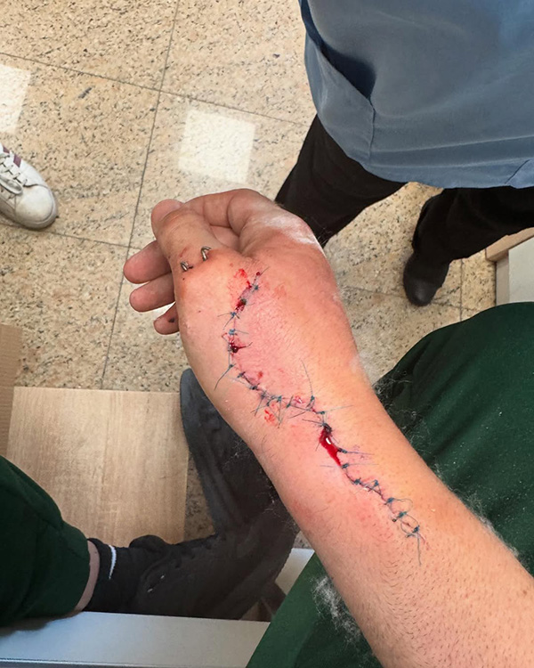 Ανδρέας Μιχαηλίδης τραυματισμένο χέρι